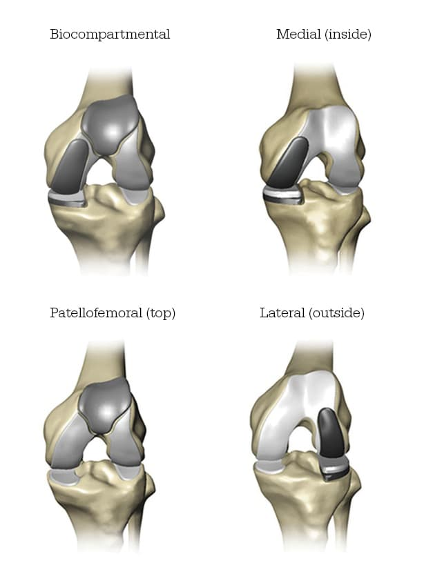 Mako SmartRobotics for Partial Knee Replacement