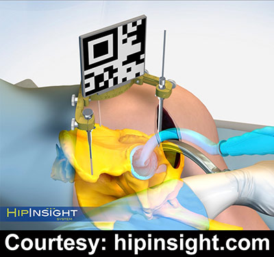 HipInsight System - total hip arthroplasty